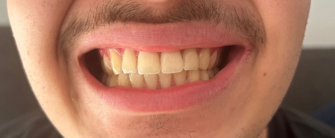 Client avant blanchiment dentaire professionnel